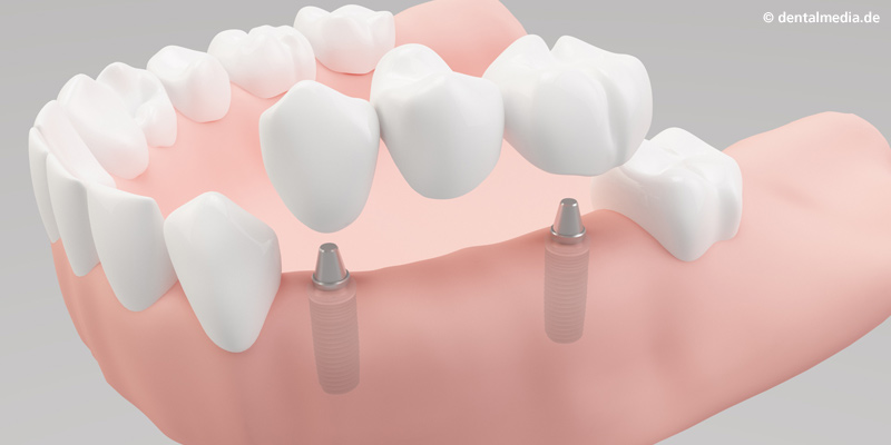 Implantate Bottrop